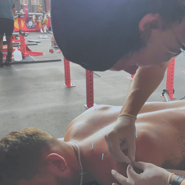 Man applying needle therapy to patient at the gym